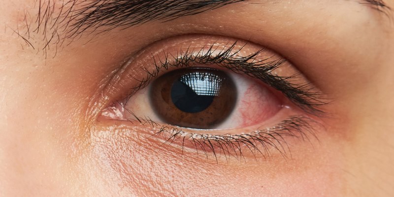 Mắt phải giật ở nữ là hiện tượng cơ mắt hoạt động không tự chủ